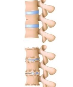 Az osteochondrosis okai