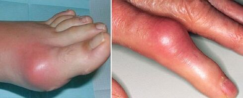 ízületi gyulladásos ízületek megjelenése