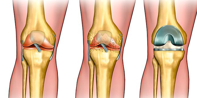 Az arthrosis harmadik szakaszában térdprotézisre van szükség