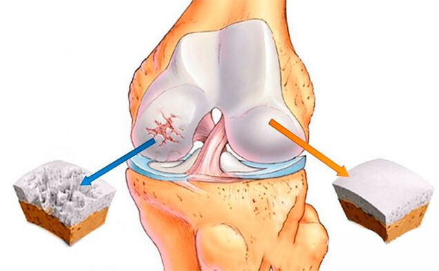 Normál térdízület (jobbra) és arthrosis által érintett (balra)