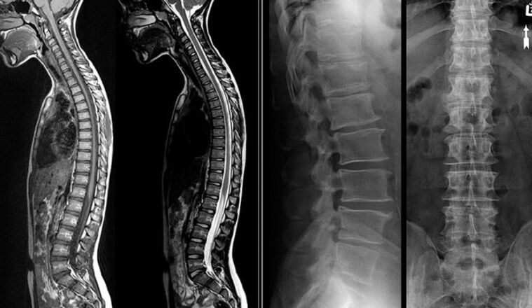 Röntgen- és MRI-képek osteochondrosisra