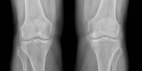 térd osteoarthritis röntgen