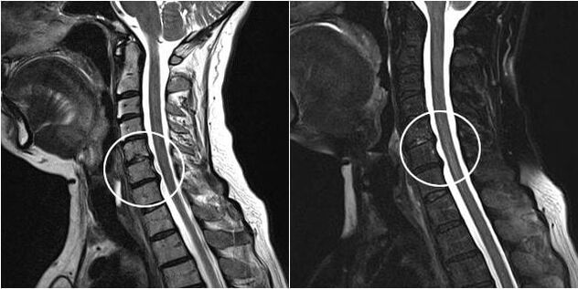 A nyaki gerinc MRI-je az osteochondrosis jeleivel