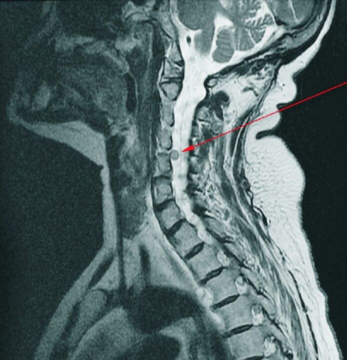 A nyaki gerinc csigolyaközi sérve MRI-n