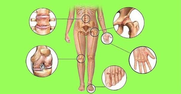 ízületi gyulladás és arthrosis által érintett ízületek