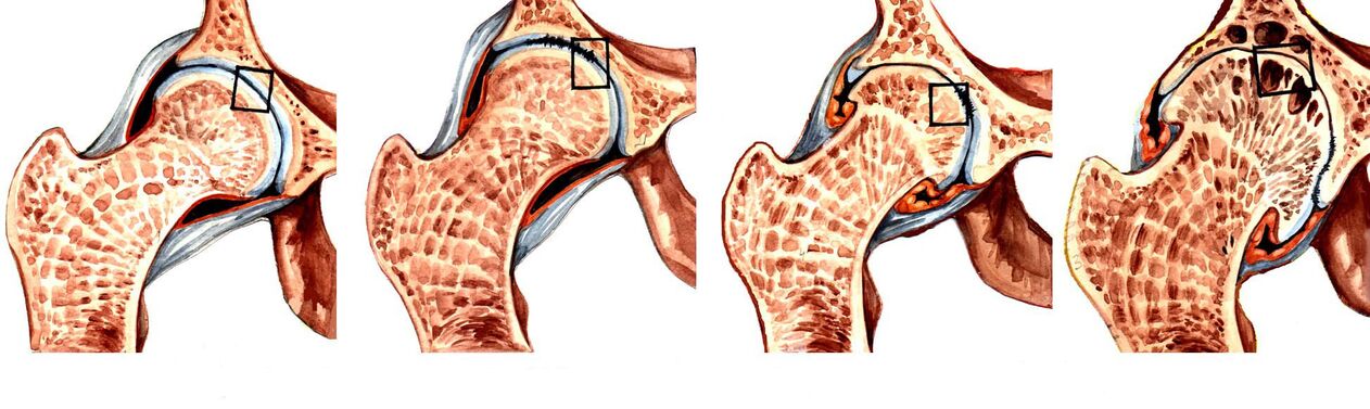 A deformáló coxarthrosis fokai