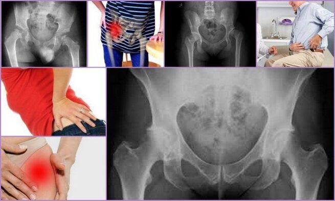 A fájdalom és a mozgáskorlátozottság a csípőízületi osteoarthritis fő tünetei