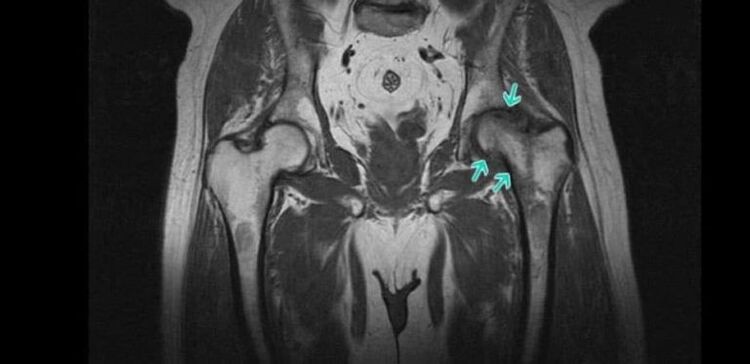 Degeneratív-dystrophiás változások a csípőízületben MRI-n