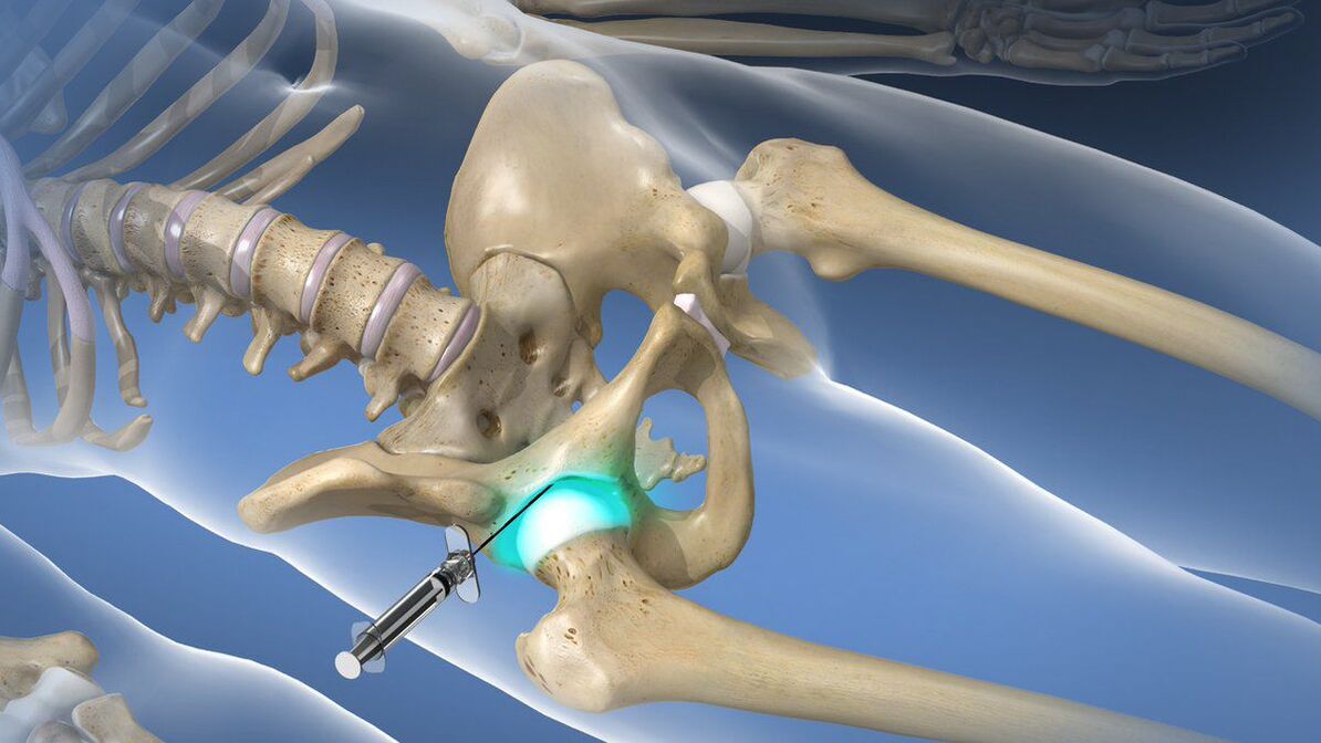 Intraartikuláris blokád az akut fájdalom megszüntetésére coxarthrosisban