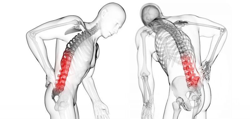 nyaki osteochondrosis okozta szövődmények